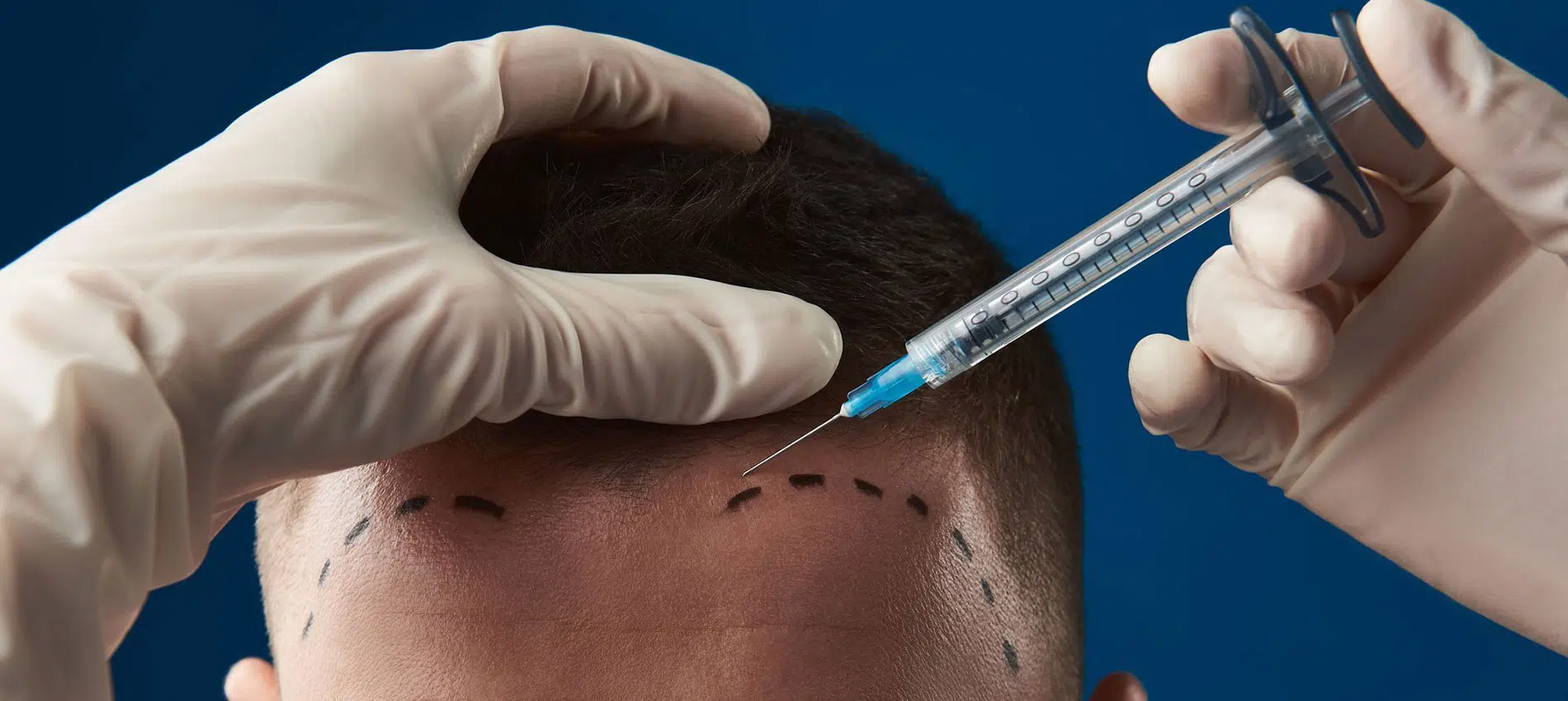 Breaking The Myth: Artificial Hair Transplant