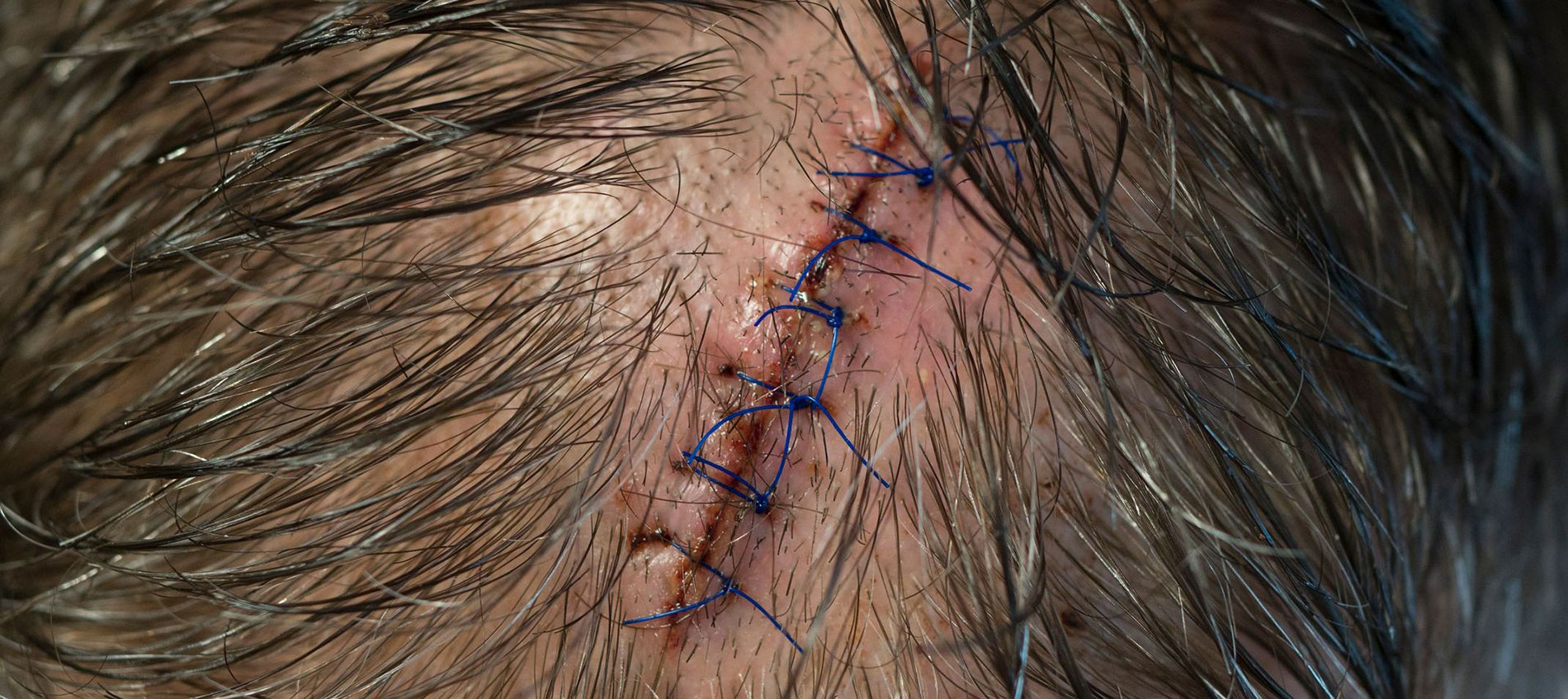 How To Avoid A Hair Transplant Scar