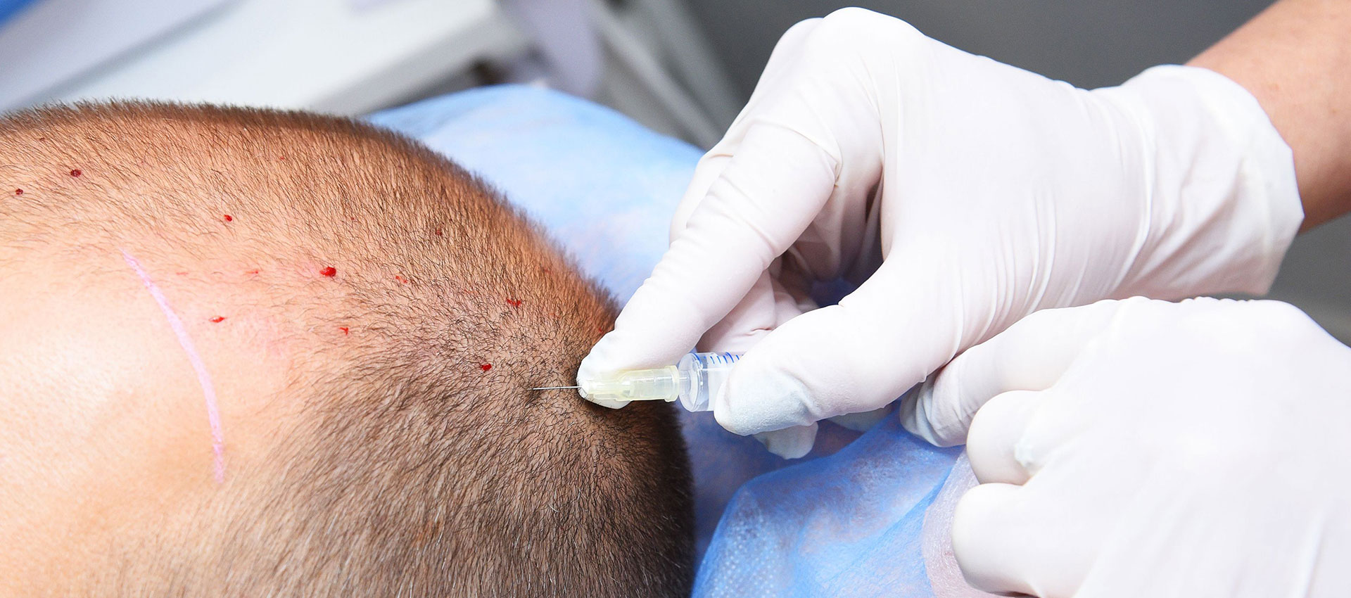 How To Prevent A Hair Transplant Infection
