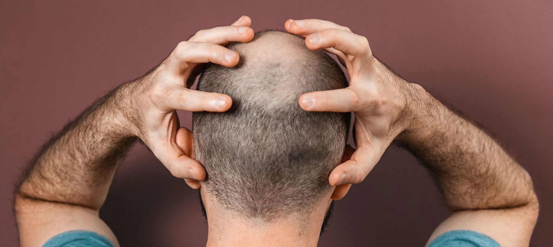 All About The Treatment Of Hair Loss