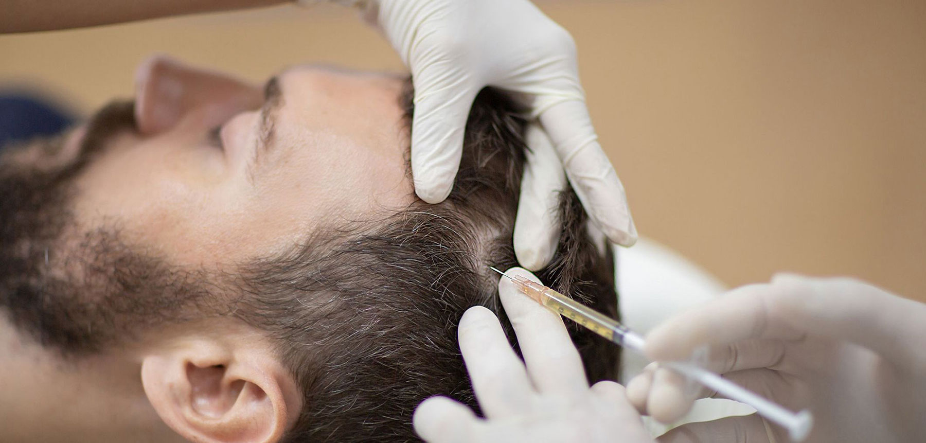Everything About PRF Hair Restoration