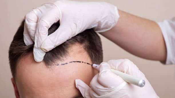 Breaking The Myth: Artificial Hair Transplant