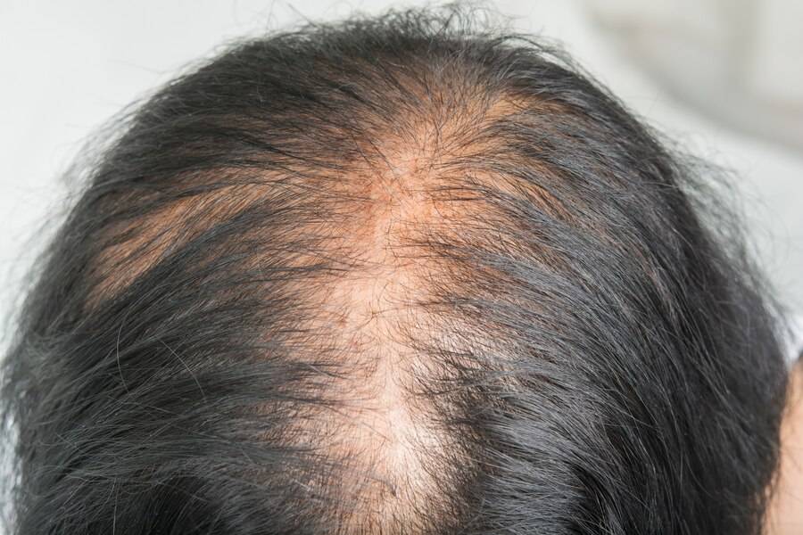 Cicatricial Alopecia - Eugenix Hair Sciences Pvt Ltd