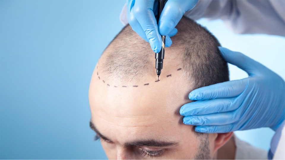 Direct Hair Transplant: A Revolution In Hair Restoration Science