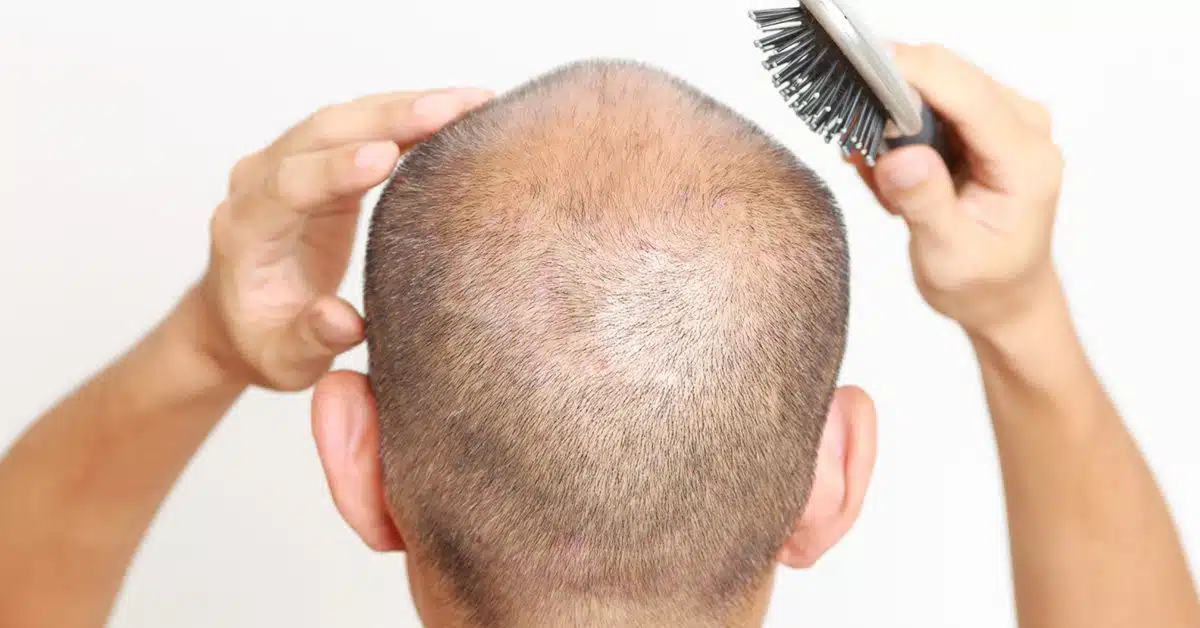 Understanding Different Hair Loss Patterns and Suitable Transplant Methods