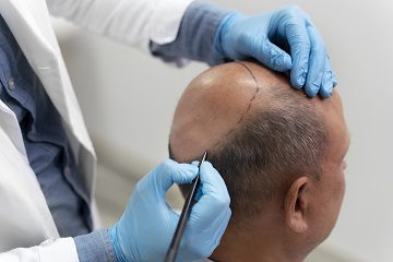 All About Hair Transplantation For Men