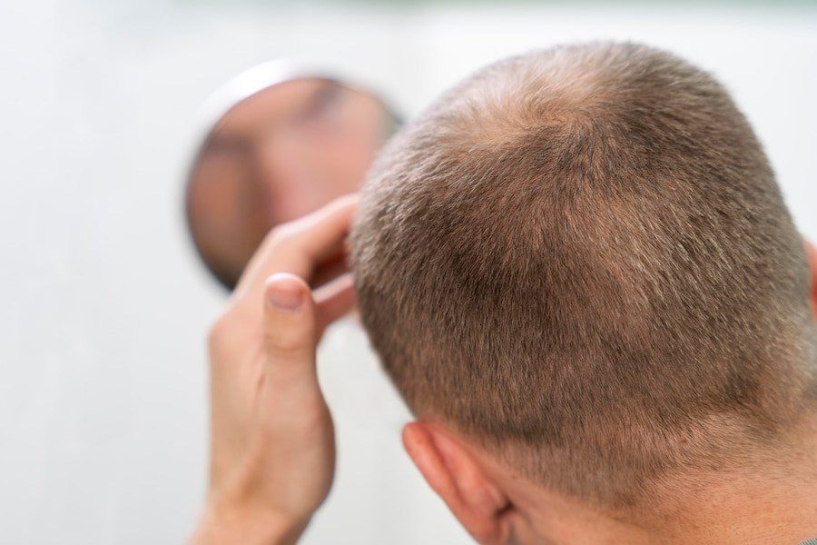 Top Things To Know Before Opting For A Hair Transplant