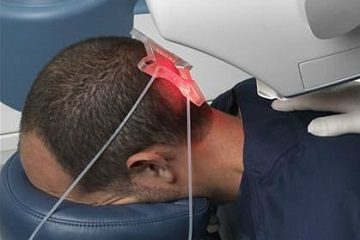 All About Robotic Hair Transplant