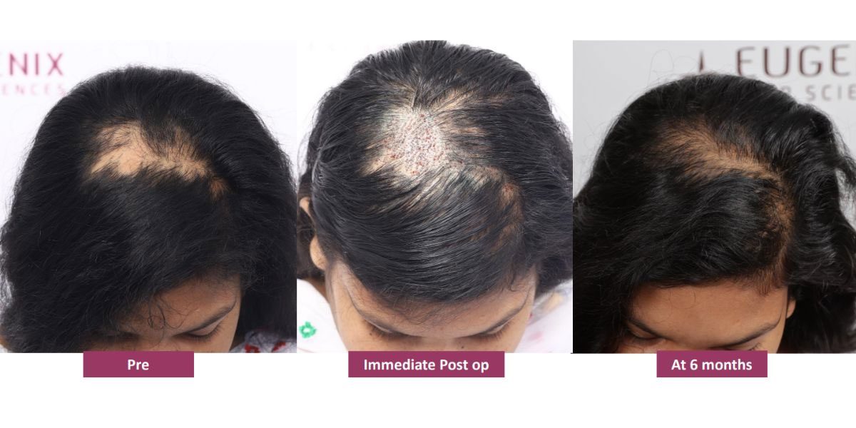 Everything You Need To Know About Hair Restoration For Women