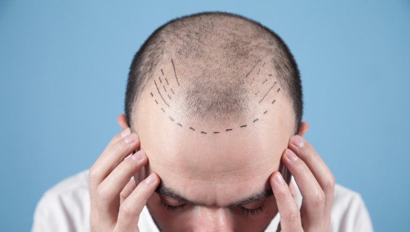 Hairline Zone – Everything You Need To Know About It