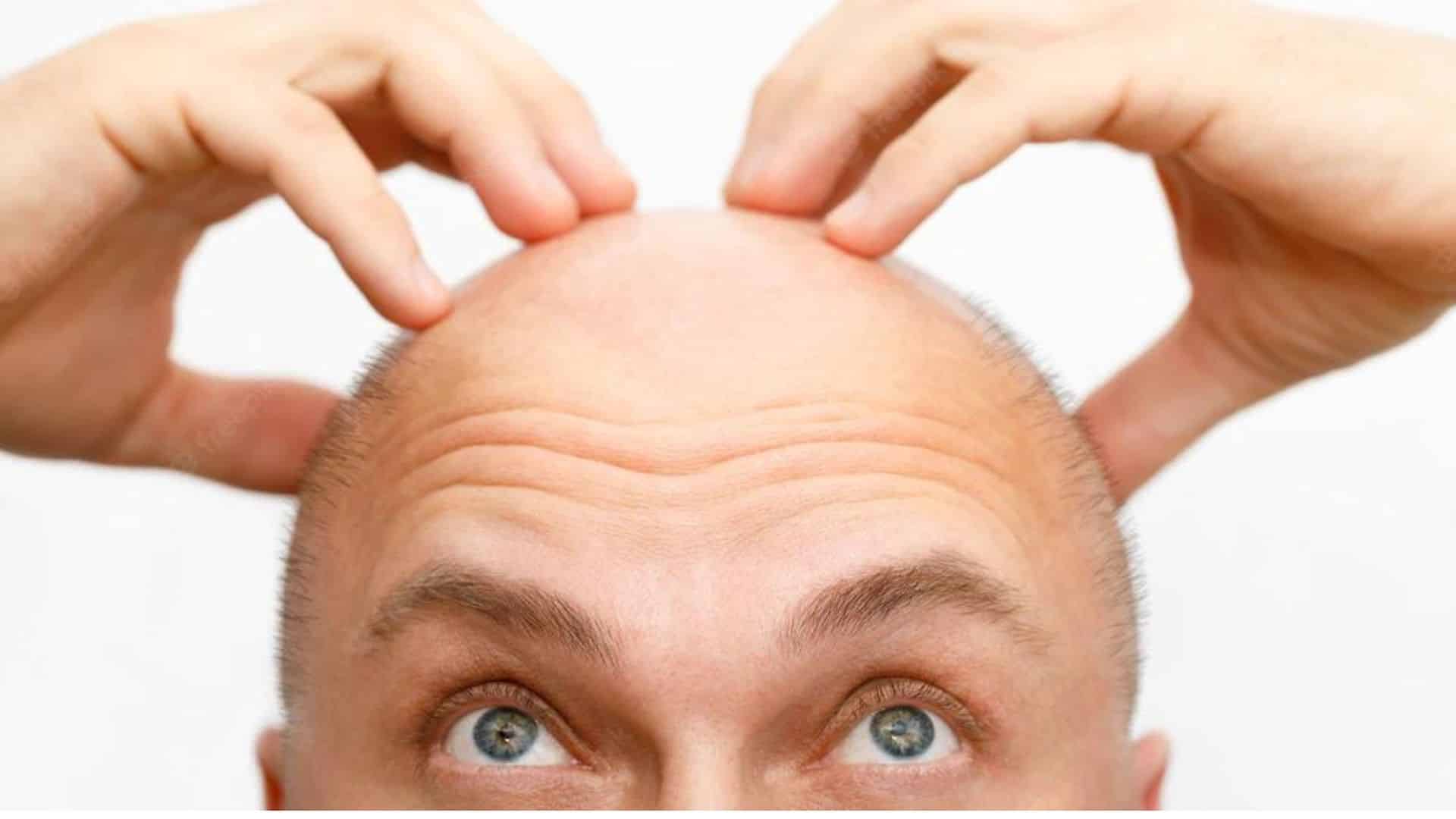 How Much Does Hair Transplant Cost?