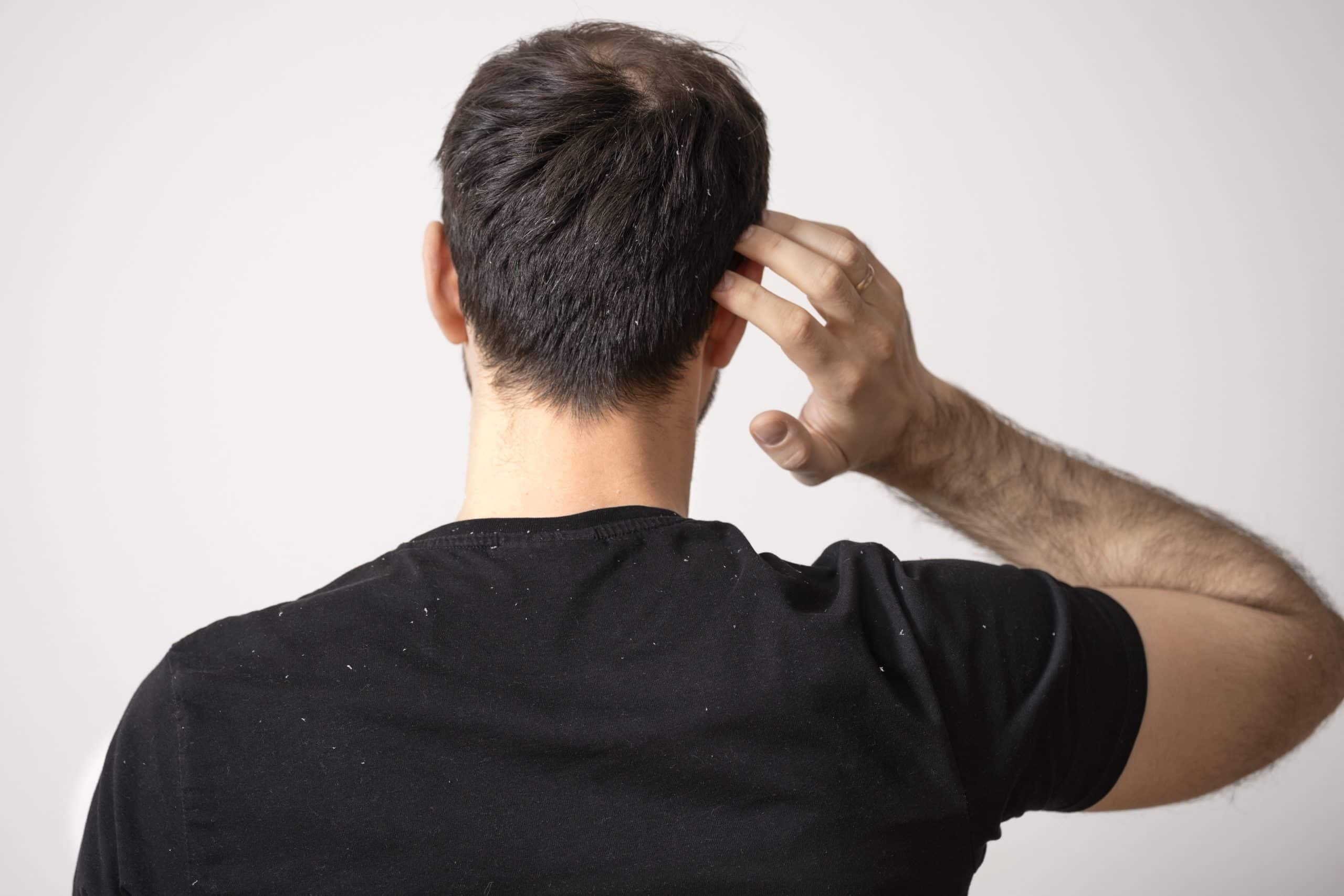 Is Dandruff Bothering You; Here Is Everything You Need To Know About It