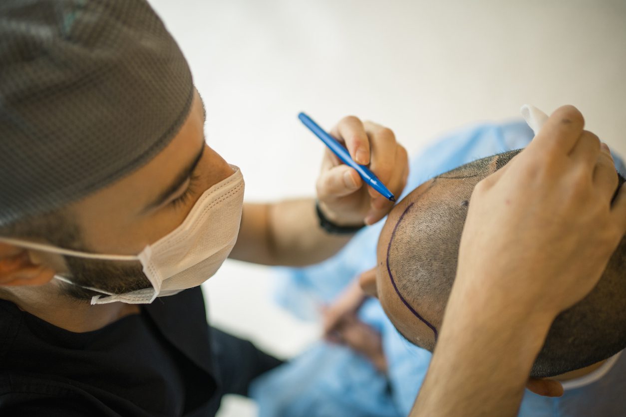 Long-term Cost Analysis: Is Hair Transplant Worth It?