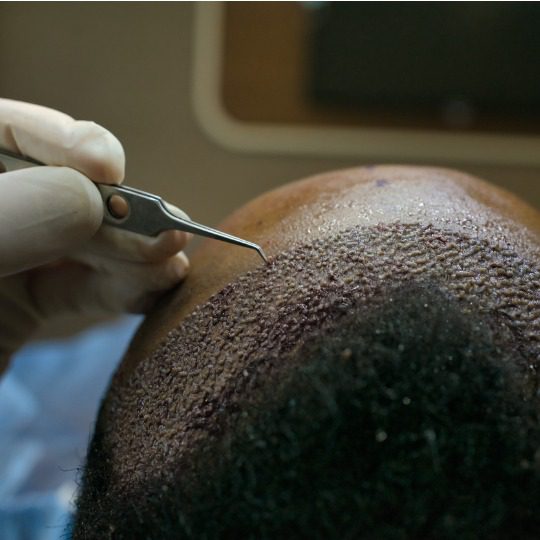 The Role of Donor Area in Achieving Permanent Hair Transplant Results