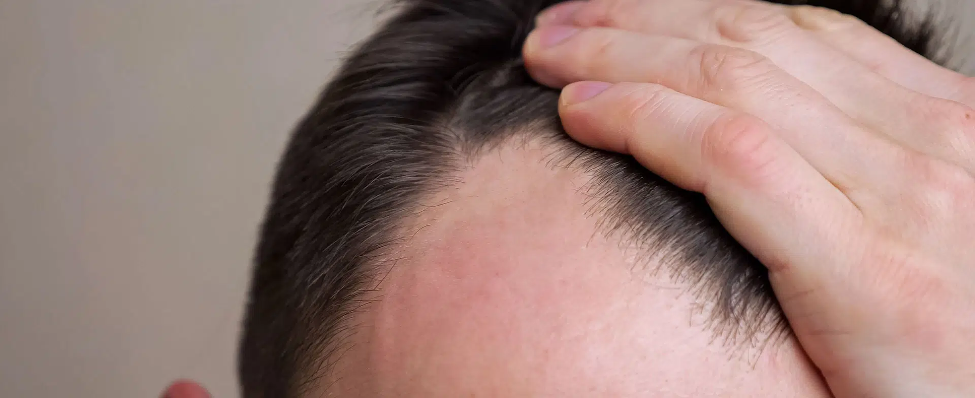 Hair Transplantation and Scarring: Minimizing Risks and Ensuring Safe Healing