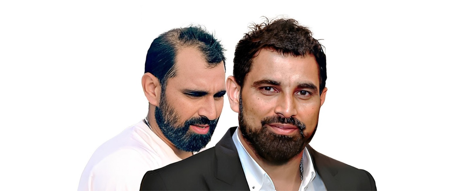 shami-hair-transplant-eugenix