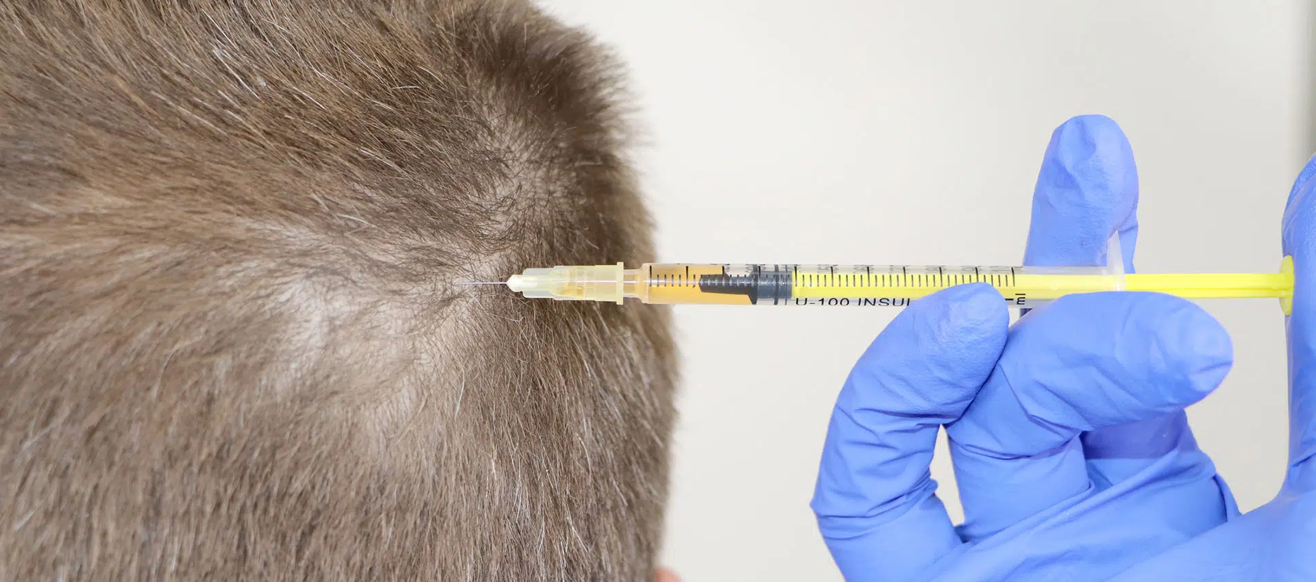 Recognizing and Avoiding Common Pitfalls: Tips for Safe Hair Transplants