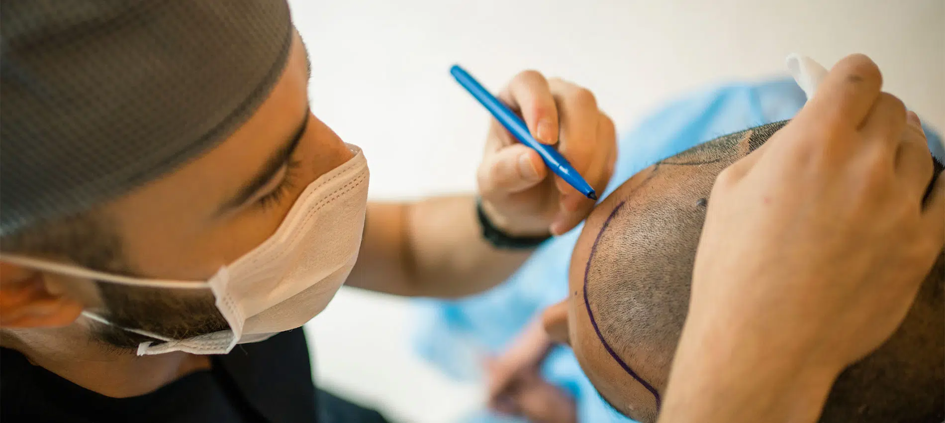 India Emerges as the Hair Transplant Capital of the World