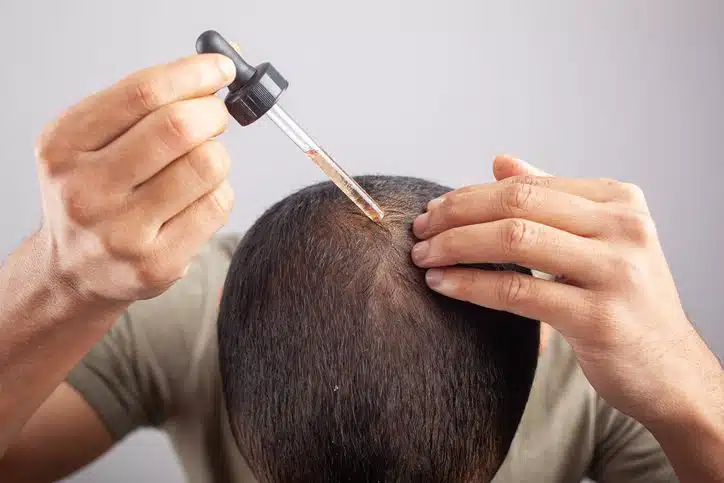 Understanding the Role of Minoxidil in Hair Restoration