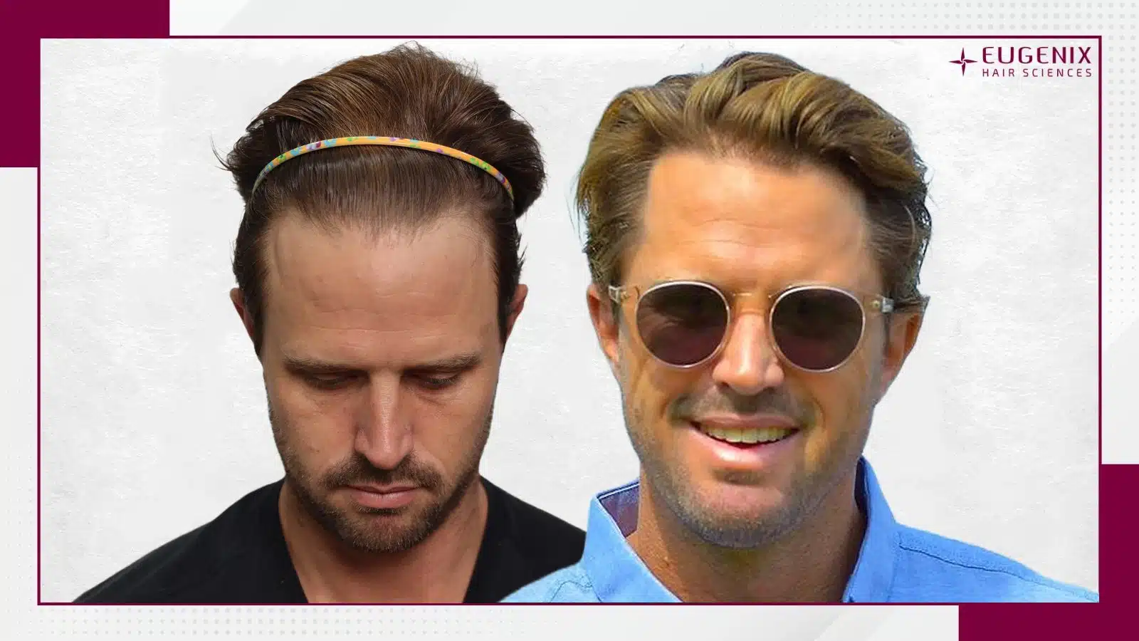 Nick Compton Hair Transplany Before and After