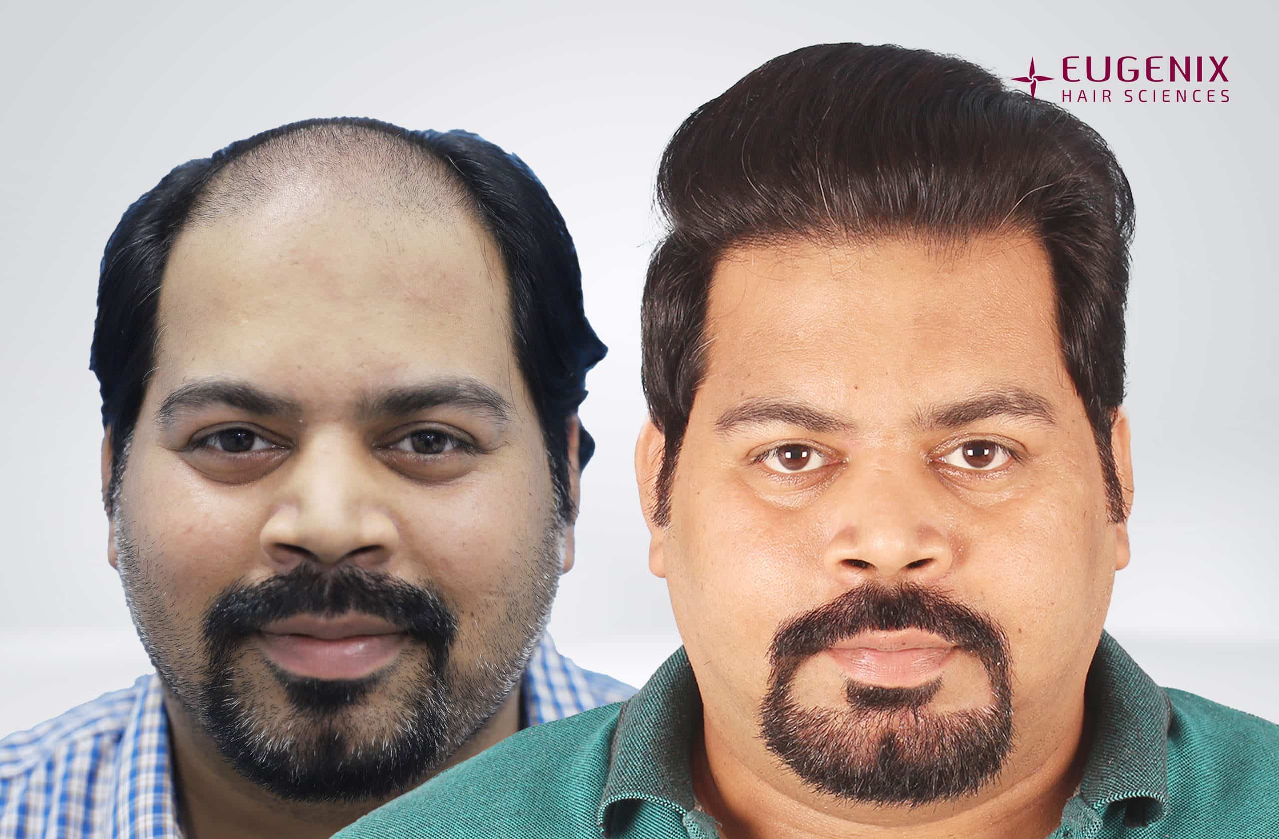 Abhinay Front Before After