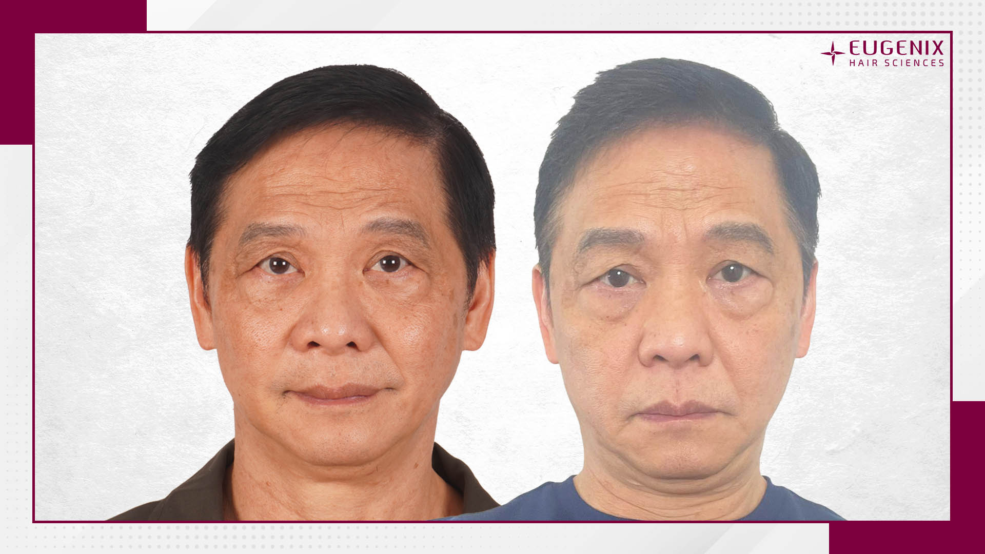 Austin Goh Eyebrow Transplant