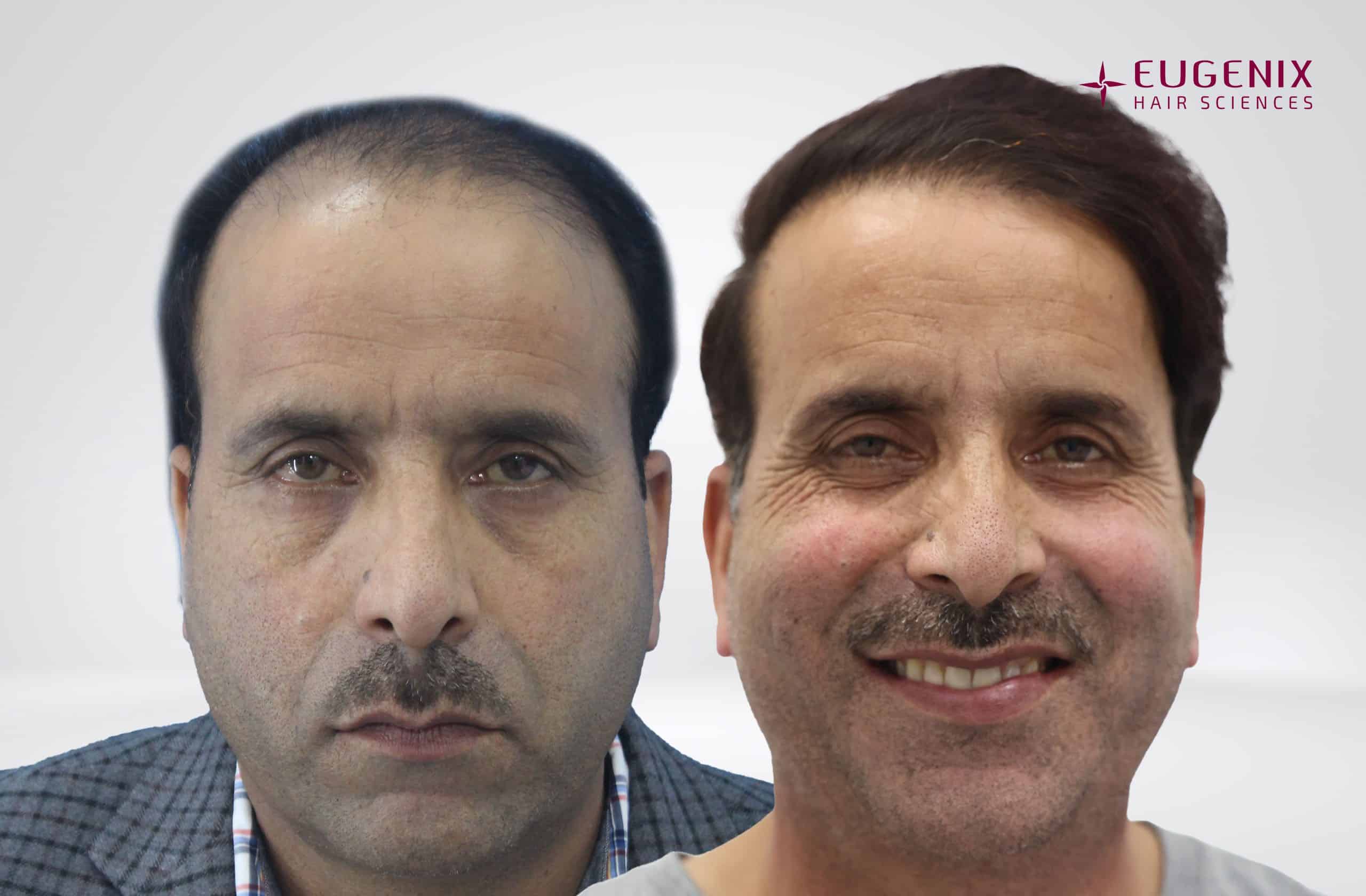 Bashir Ahamad Before and After