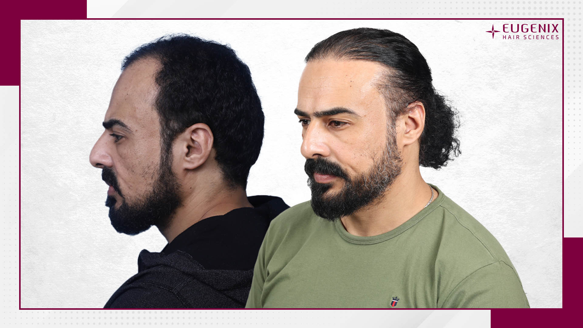 Beard Hair Transplant Website Image Border with before after