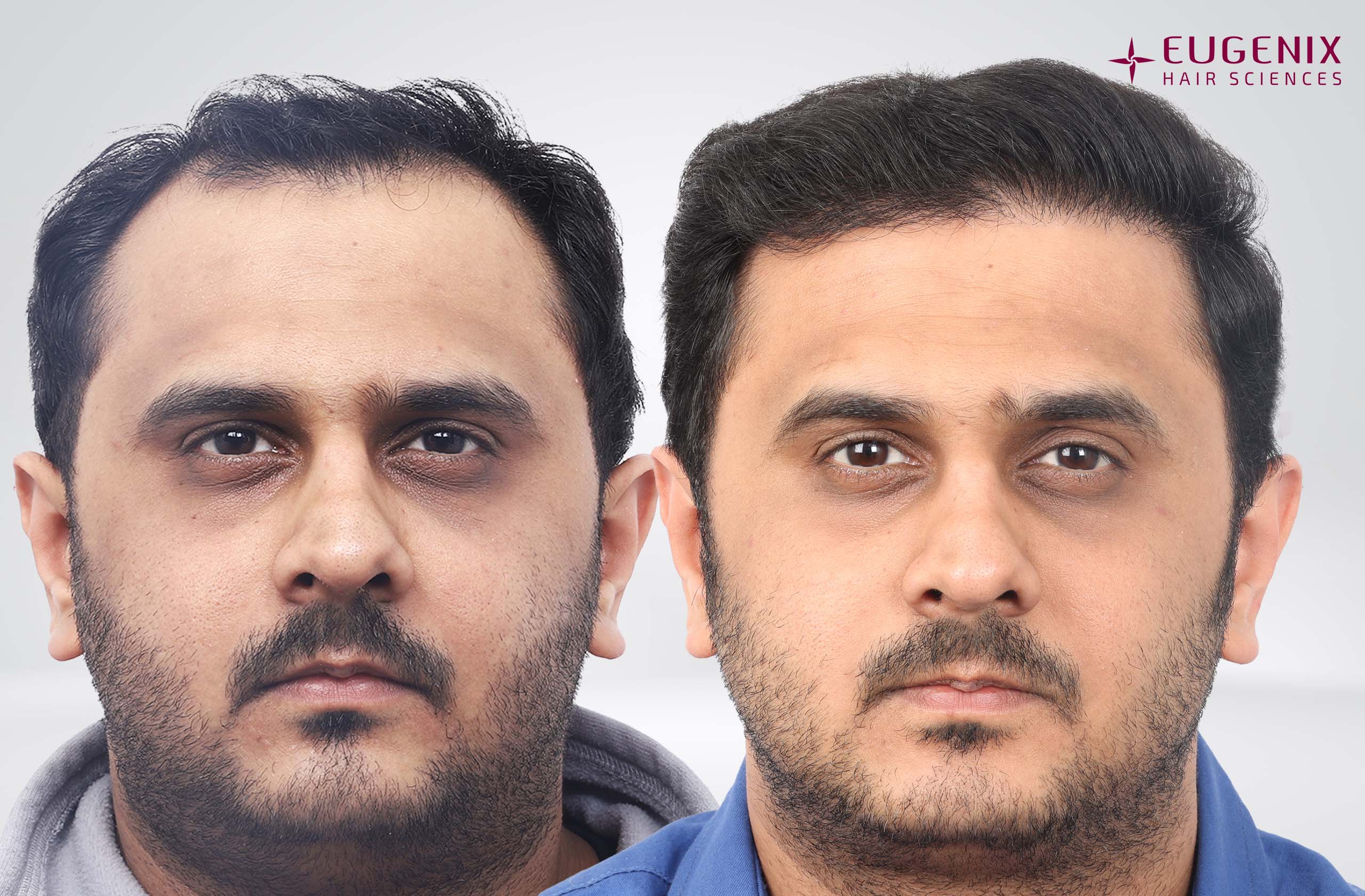 Faizan Front Before After