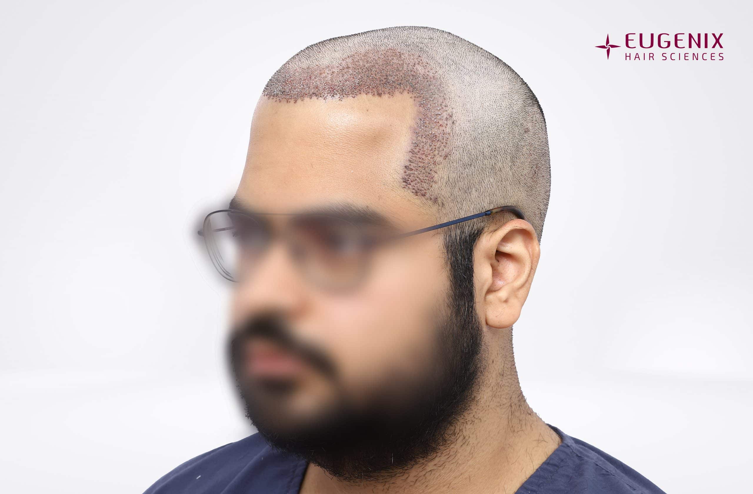 Harshit Aggarwal Right Post-op