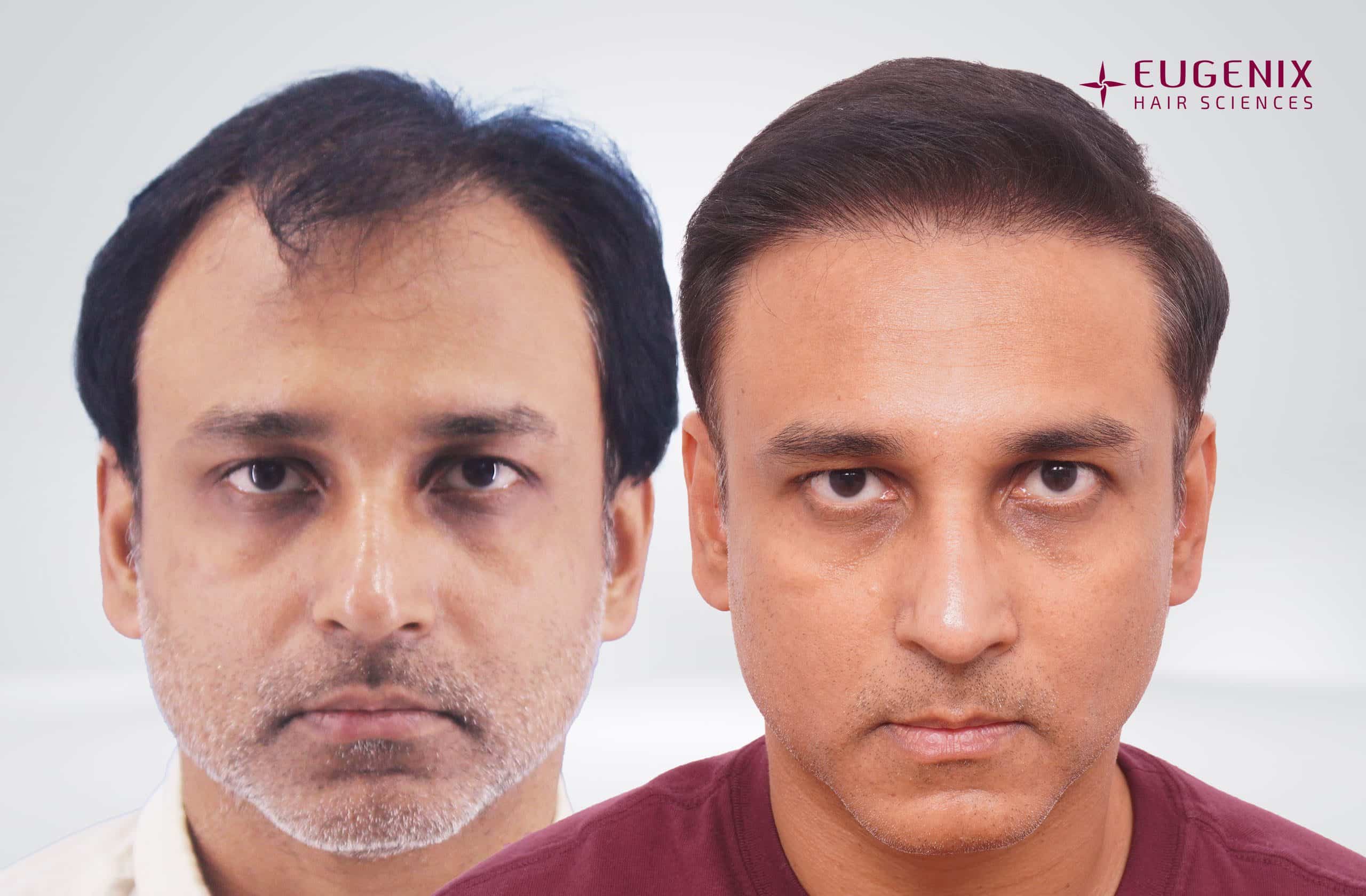 Rahul Front Before After