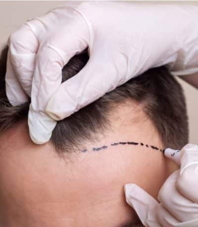 calculate grafts for hair transplant