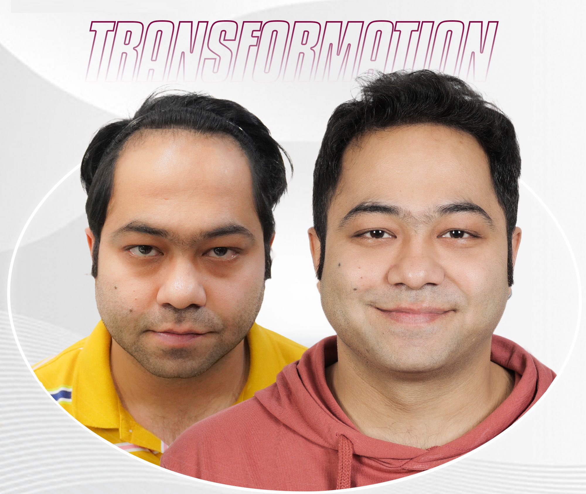 celebrity hair transplant
