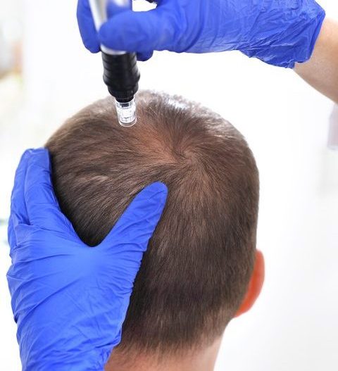 crown hair transplant procedure