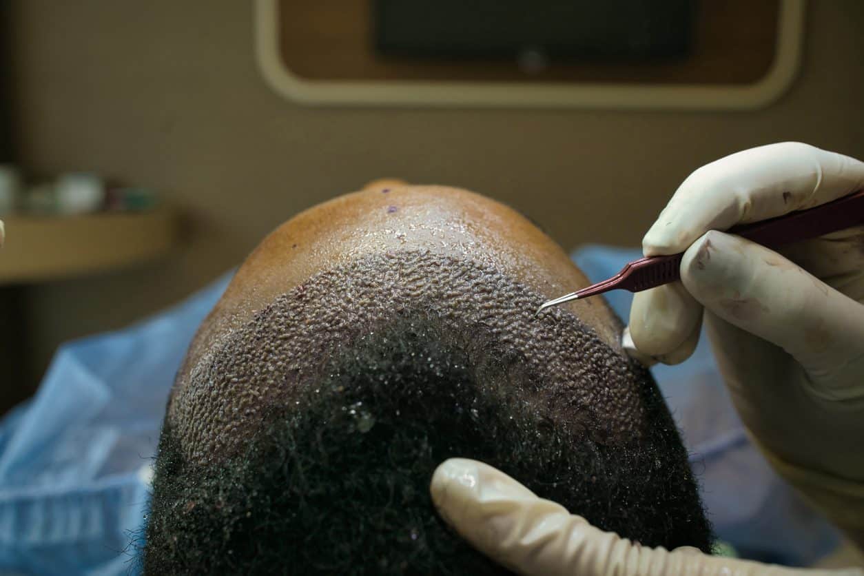 direct hair transplant technique