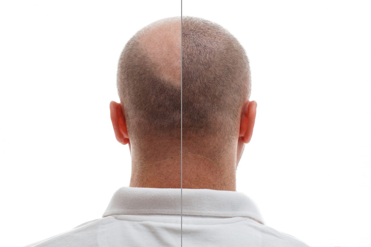 The Hair Transplant Journey: Navigating the 3rd to 6th Month After Your Procedure