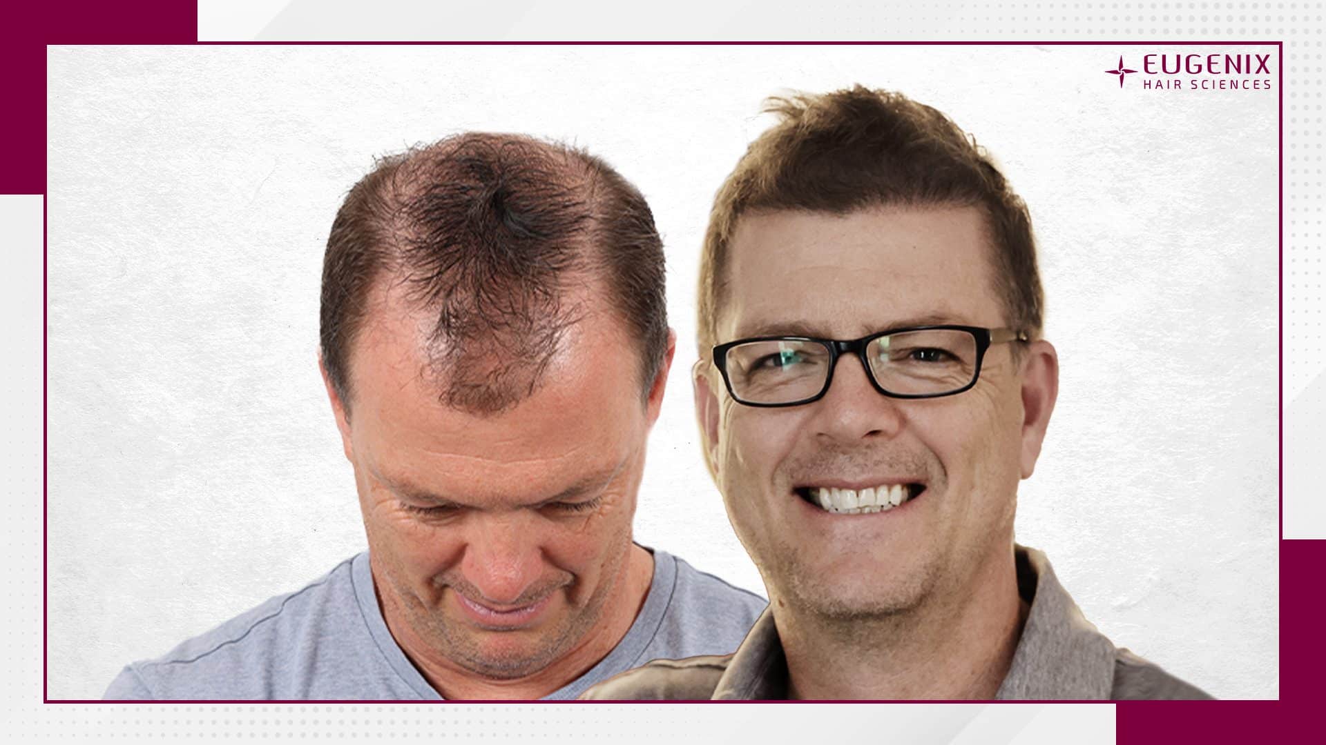 male-hair-transplant-before-and-after-10