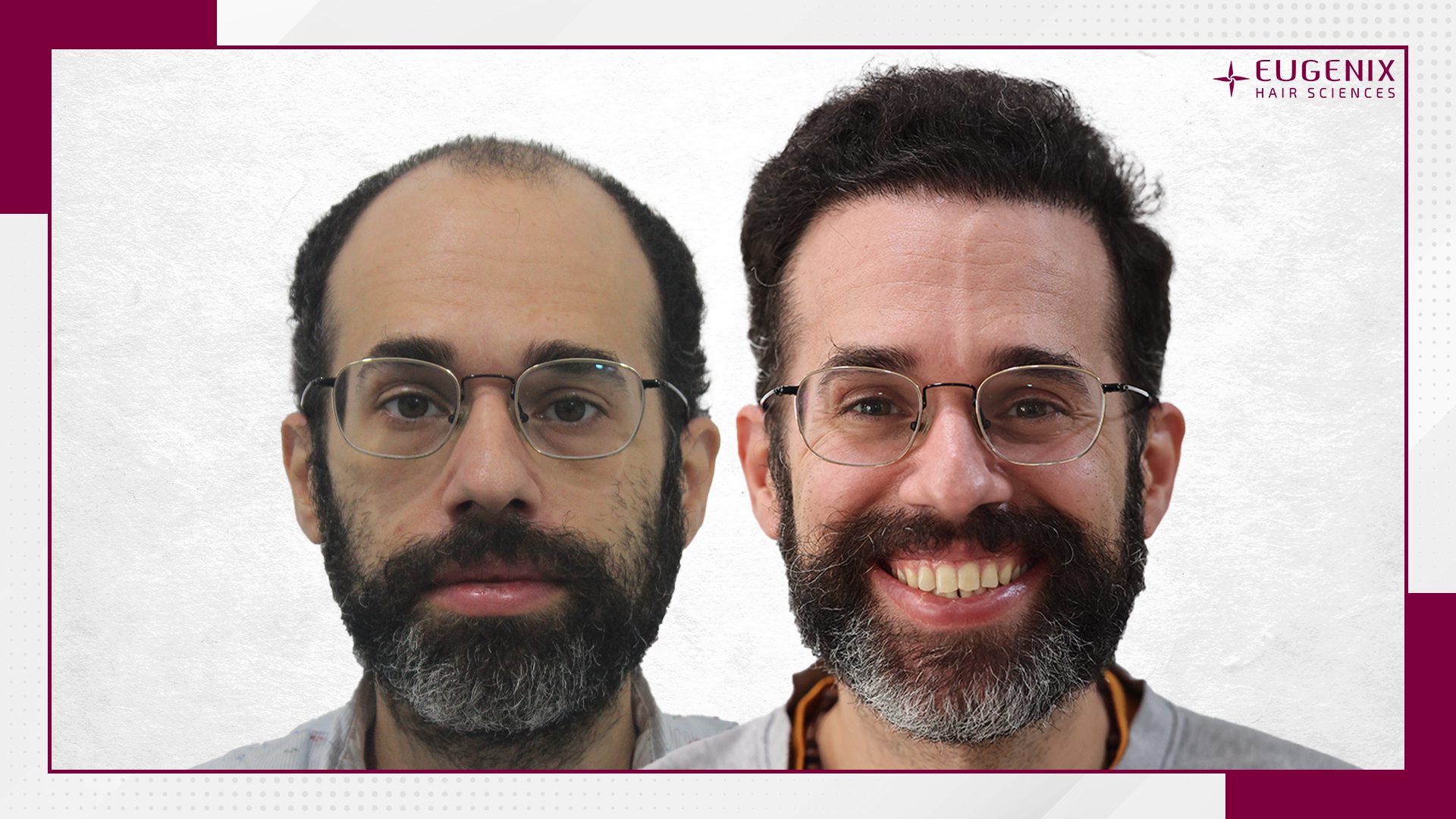 male-hair-transplant-before-and-after-11
