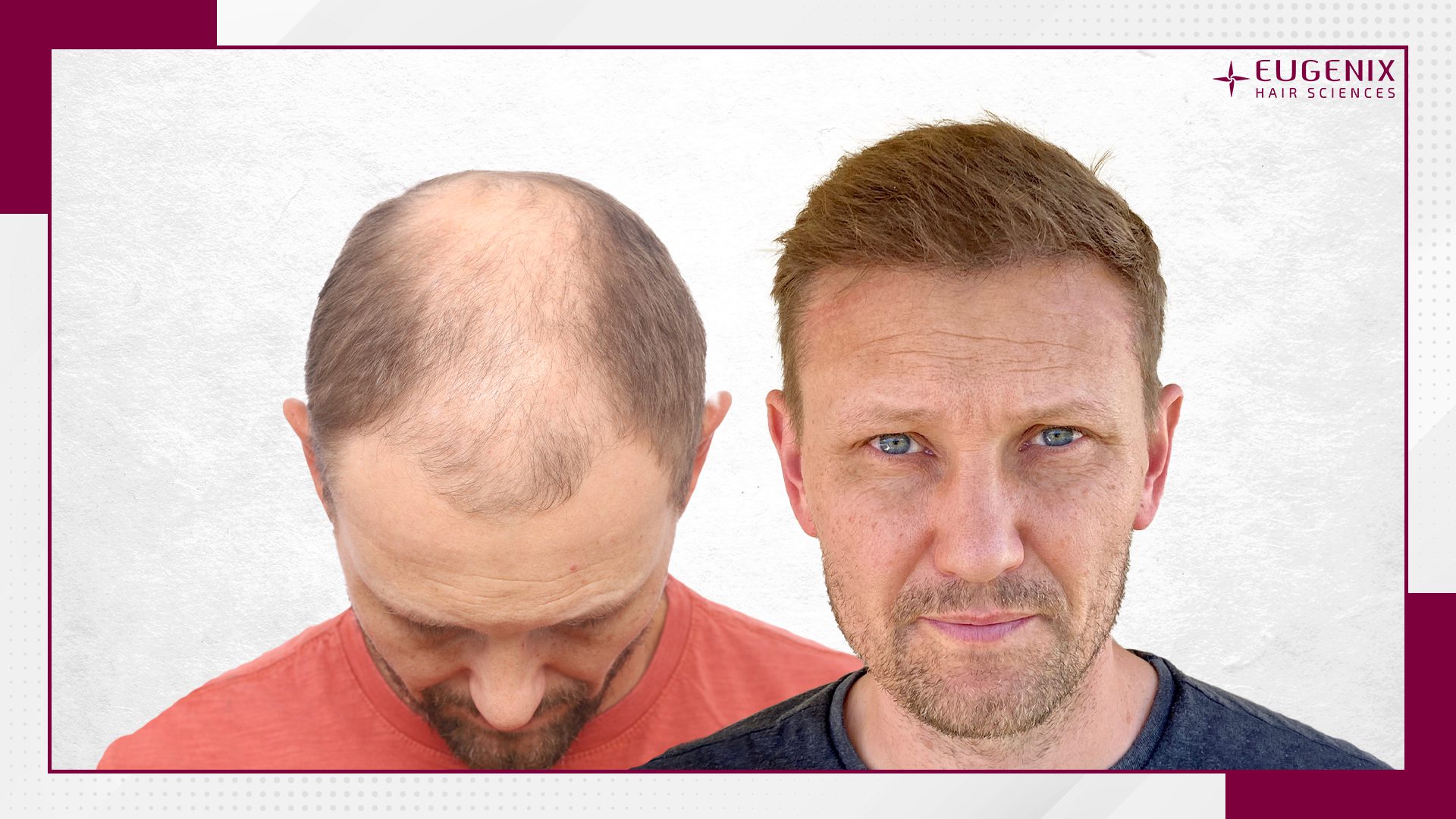 male-hair-transplant-before-and-after-12