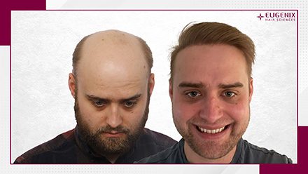 male-hair-transplant-before-and-after-14
