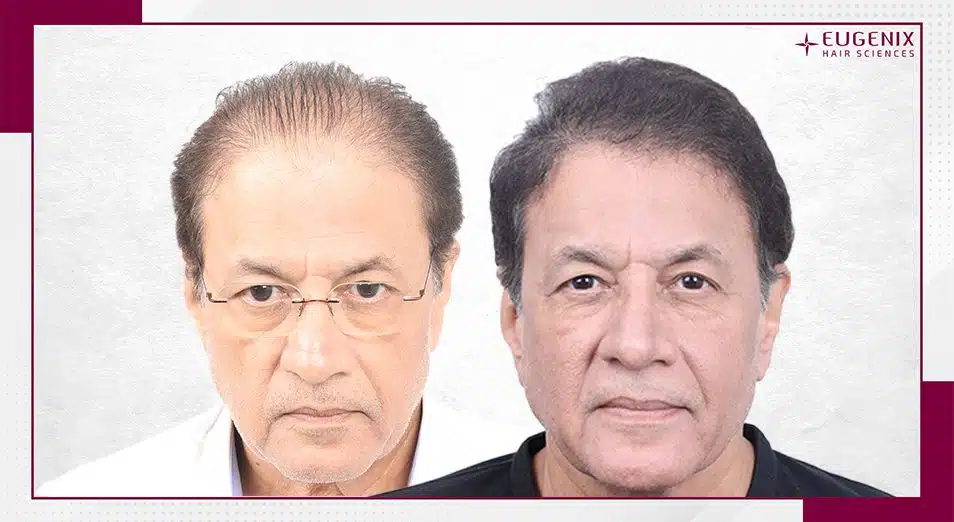 Arun Govil - Male Hair Transplant Before and After