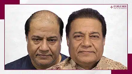 Anup Jalota hair transplant before and after