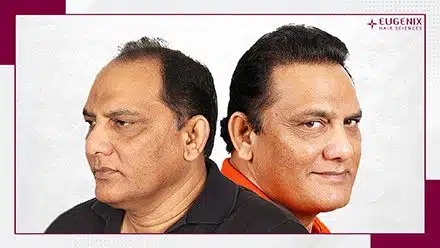 Mohammad azharuddin - male hair transplant before and after