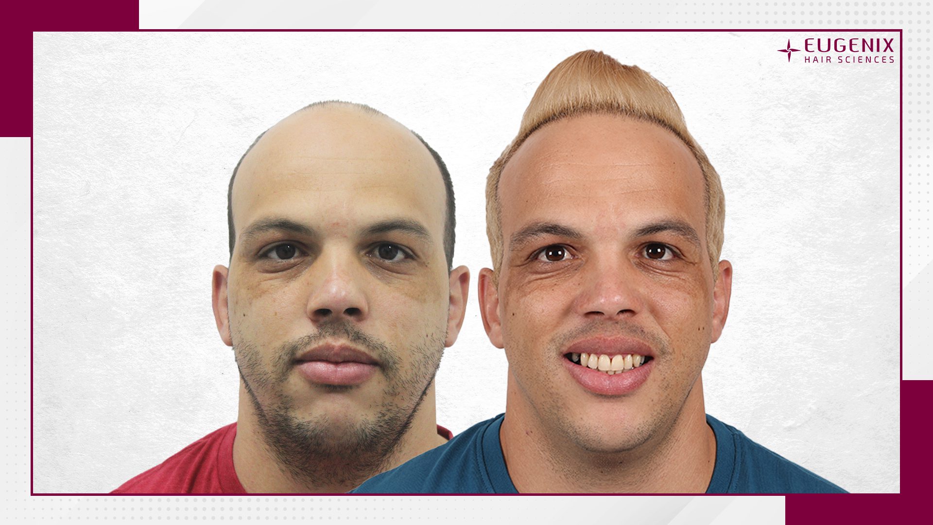 male-hair-transplant-before-and-after-7