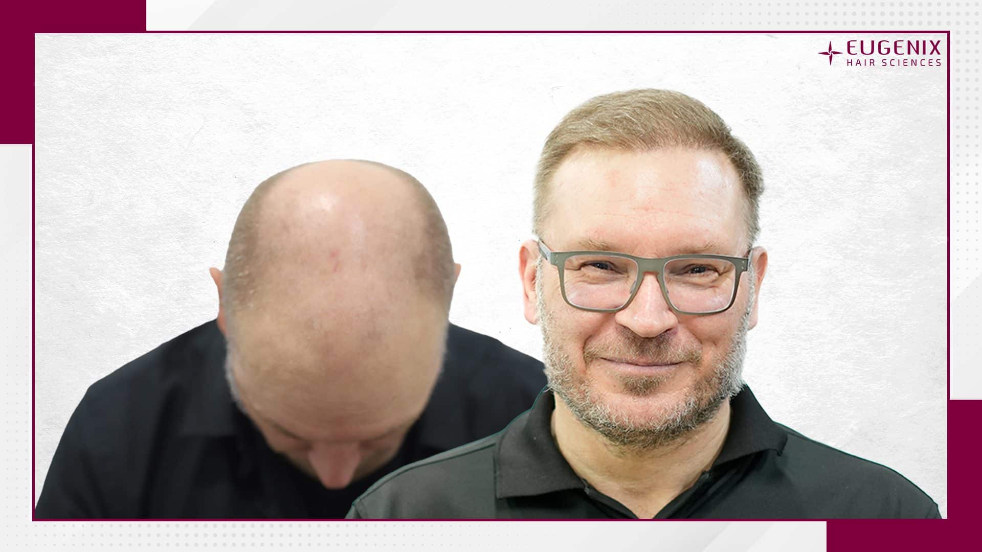 male-hair-transplant-before-and-after-8