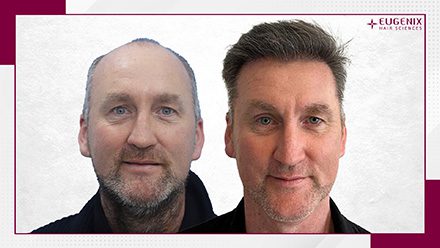 Karl Whelan - male hair transplant before and after