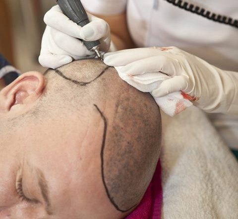 receding hairline reconstruction procedure