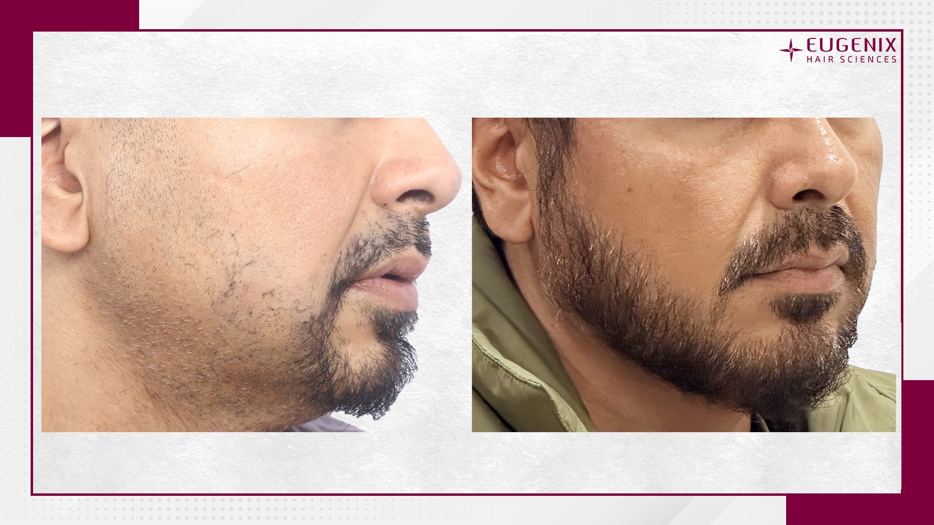 beard-mustache-hair-transplant-1