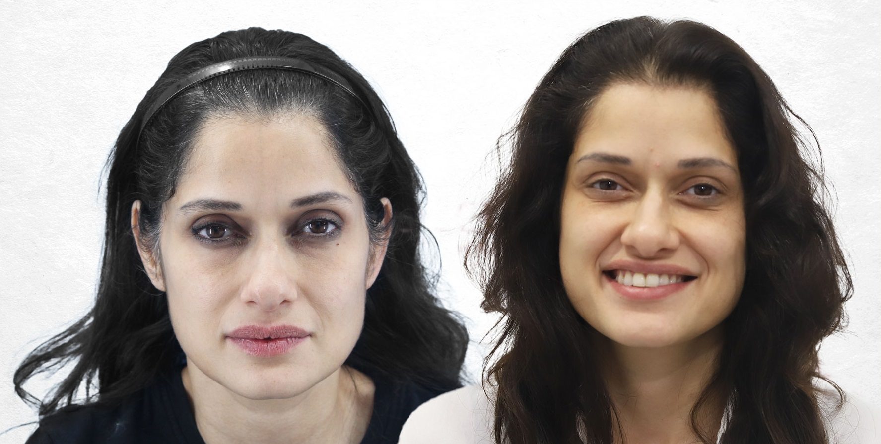 female-hair-transplant-before-after