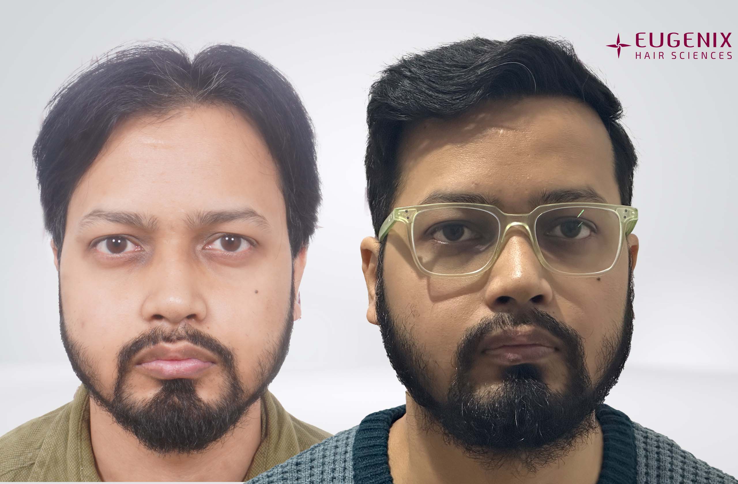 Ankur Front Before After